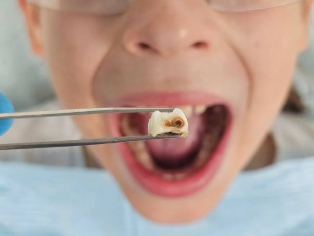 Best Emergency Wisdom Teeth Removal in Orland Park, IL